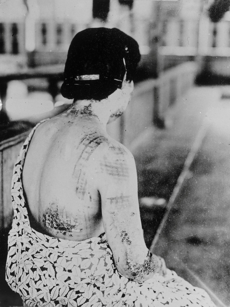 En kvinna vårdas för skador efter atombomben över Nagasaki 1945. Foto: TT